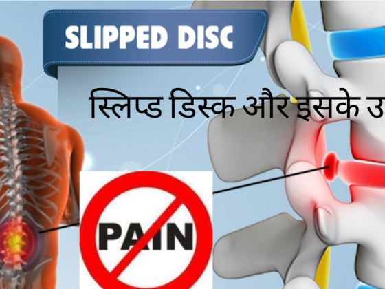 स्लिप्ड डिस्क और इसके उपचार 