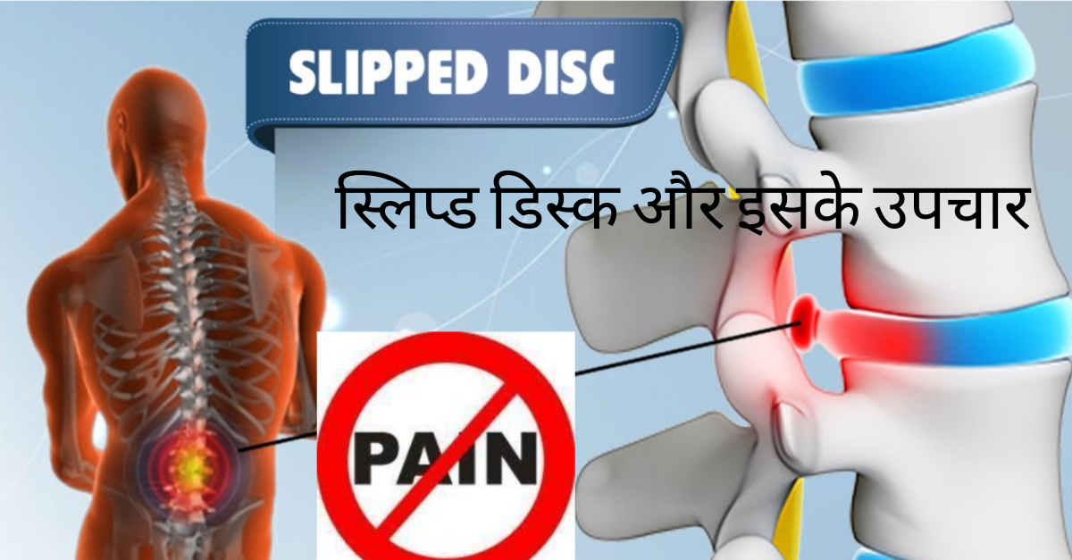 Slipped Disc