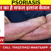 psoriasis treatment
