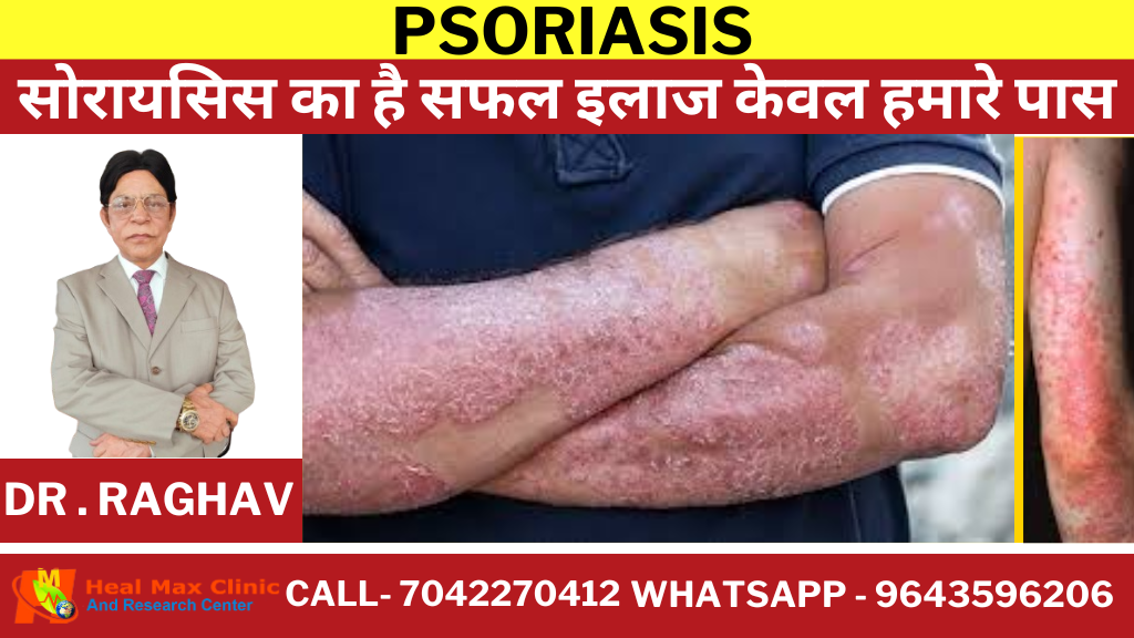 psoriasis treatment